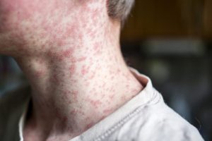 Read more about the article CDPHE alerts public of measles exposure locations in Mesa County