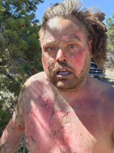 Read more about the article Colorado man warns about fire preparedness after suffering severe burns in mechanical accident